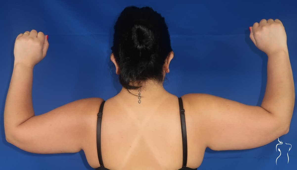 Arm Lift, before — actual patient of Dr. Day
