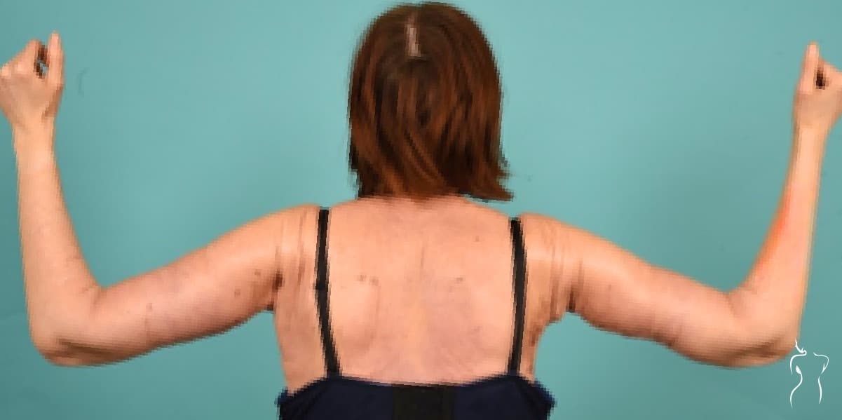 Arm Lift, after — actual patient of Dr. Day