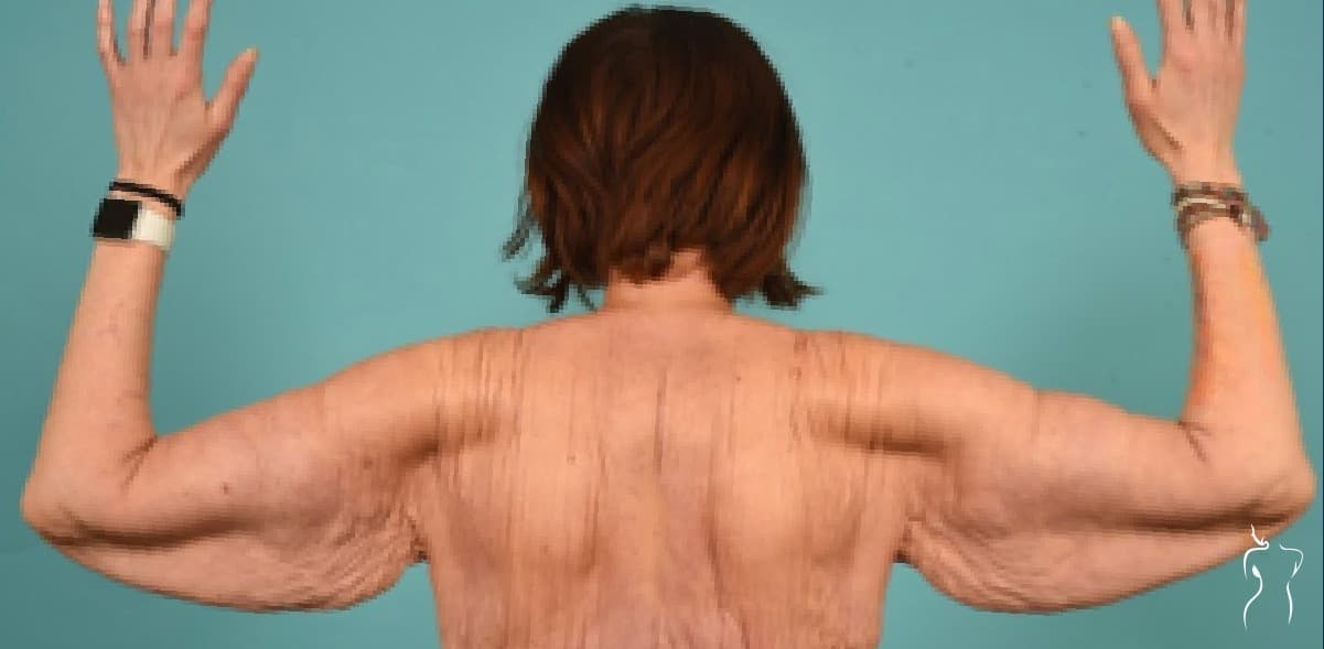 Arm Lift, before — actual patient of Dr. Day