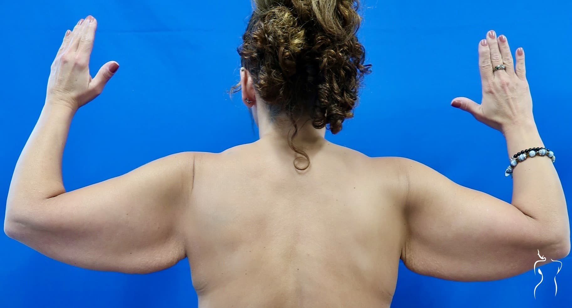 Arm Lift, before — actual patient of Dr. Day