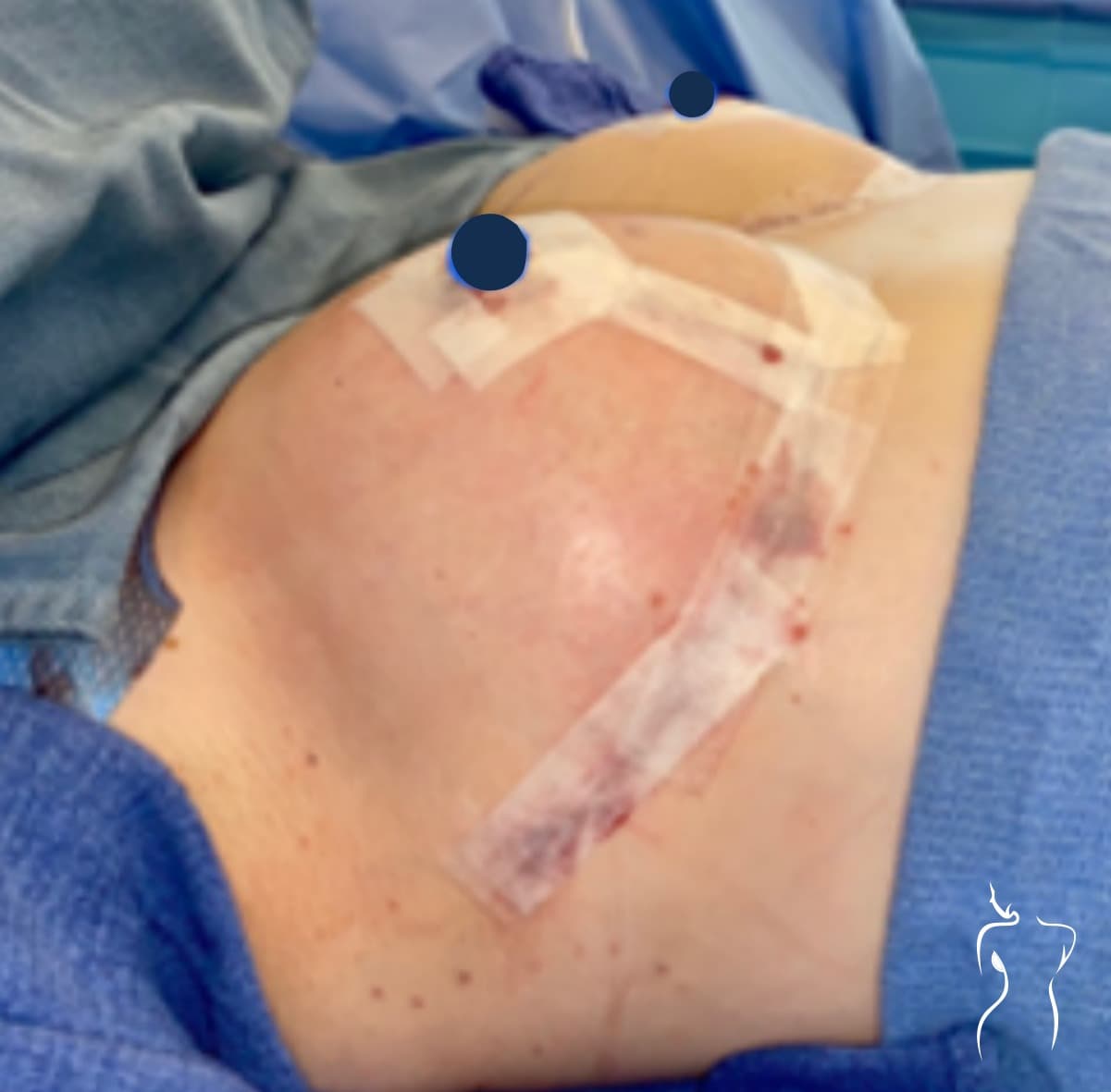 Breast Lift, after — actual patient of Dr. Day