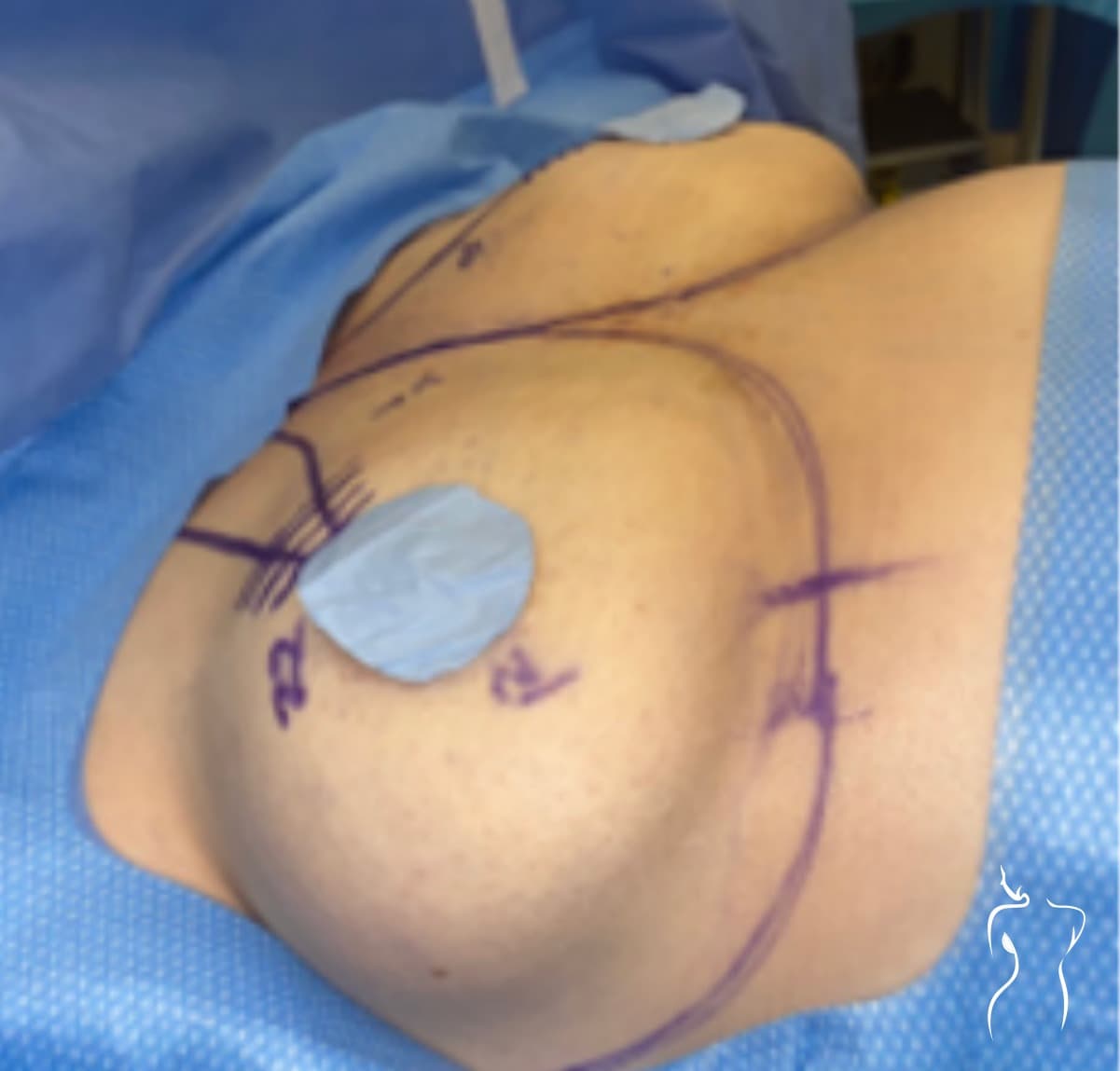 Breast Lift, before — actual patient of Dr. Day