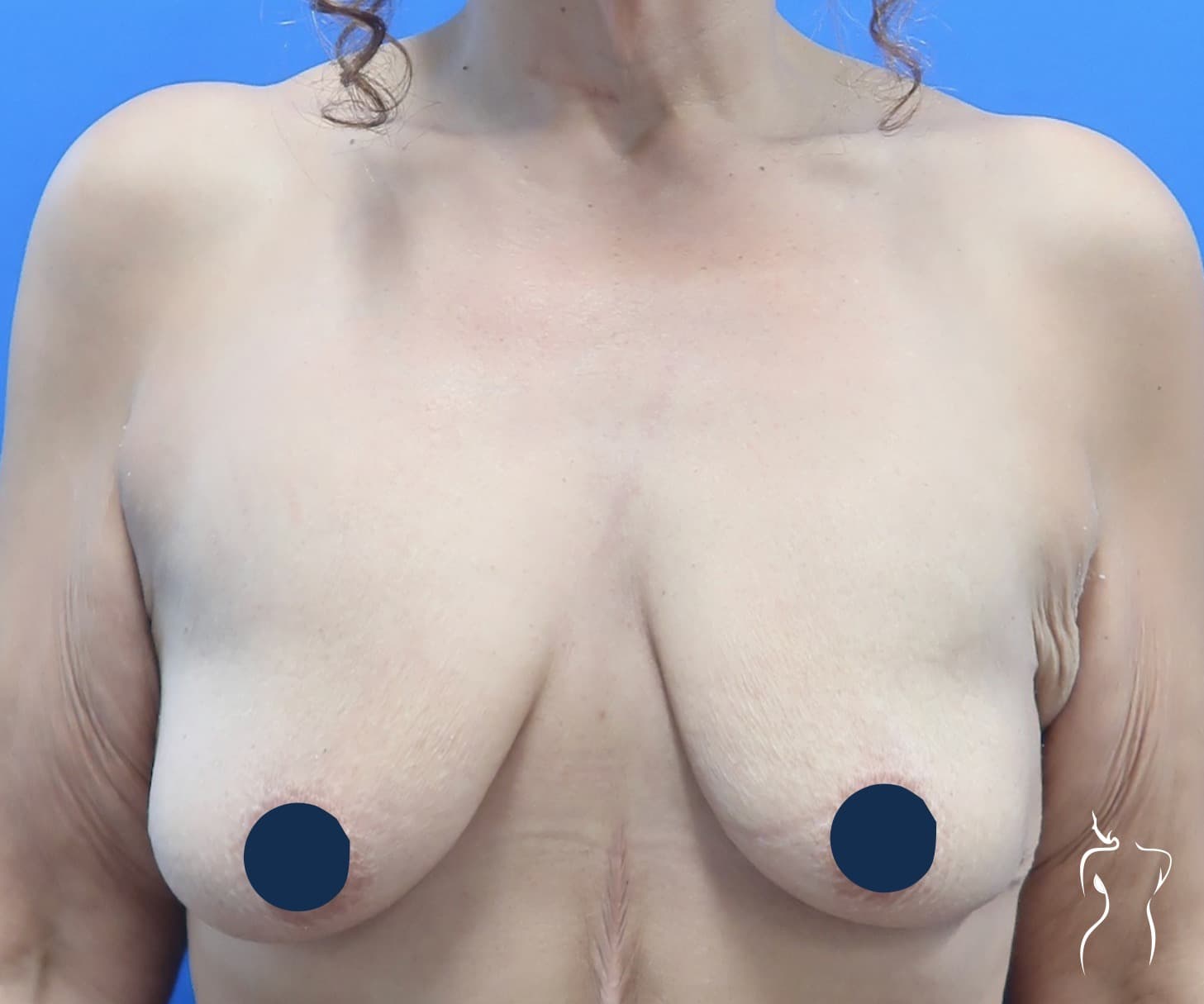 Breast Lift, before — actual patient of Dr. Day