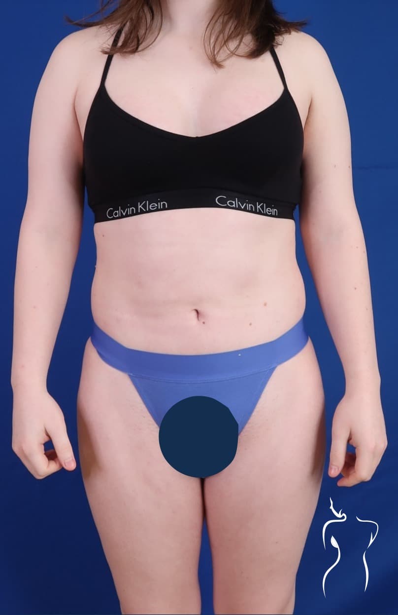 Brazilian Butt Lift, after — actual patient of Dr. Day