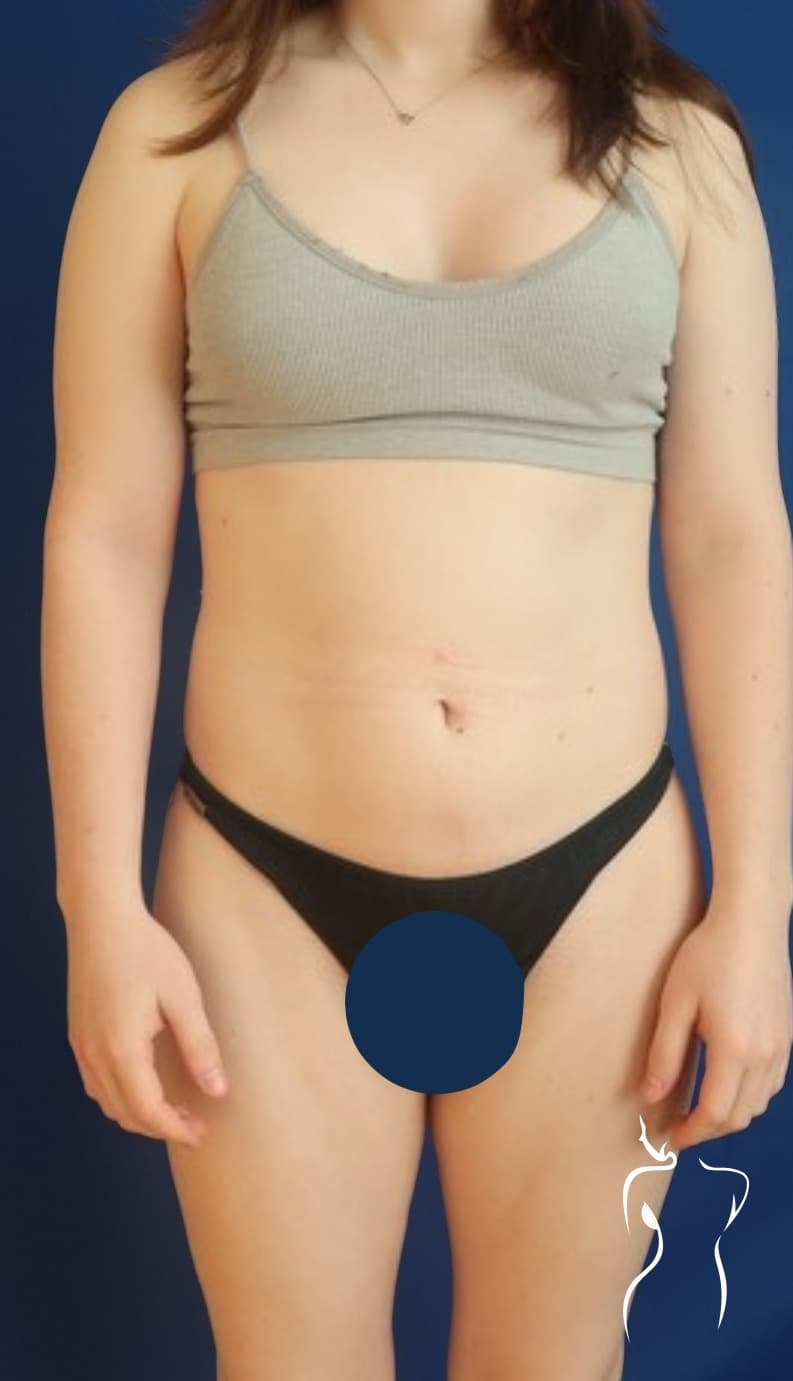 Brazilian Butt Lift, before — actual patient of Dr. Day