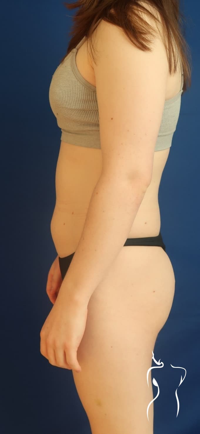 Brazilian Butt Lift (Side Views), before — actual patient of Dr. Day