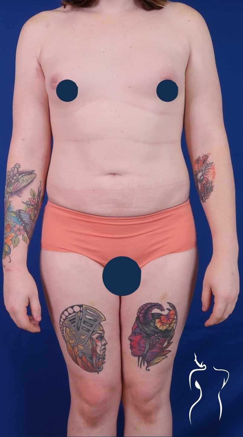 Brazilian Butt Lift, after — actual patient of Dr. Day