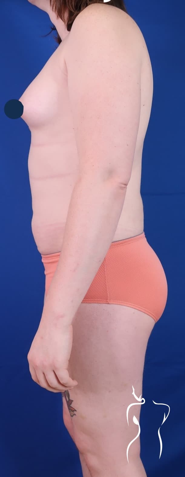 Brazilian Butt Lift (Side Views), after — actual patient of Dr. Day