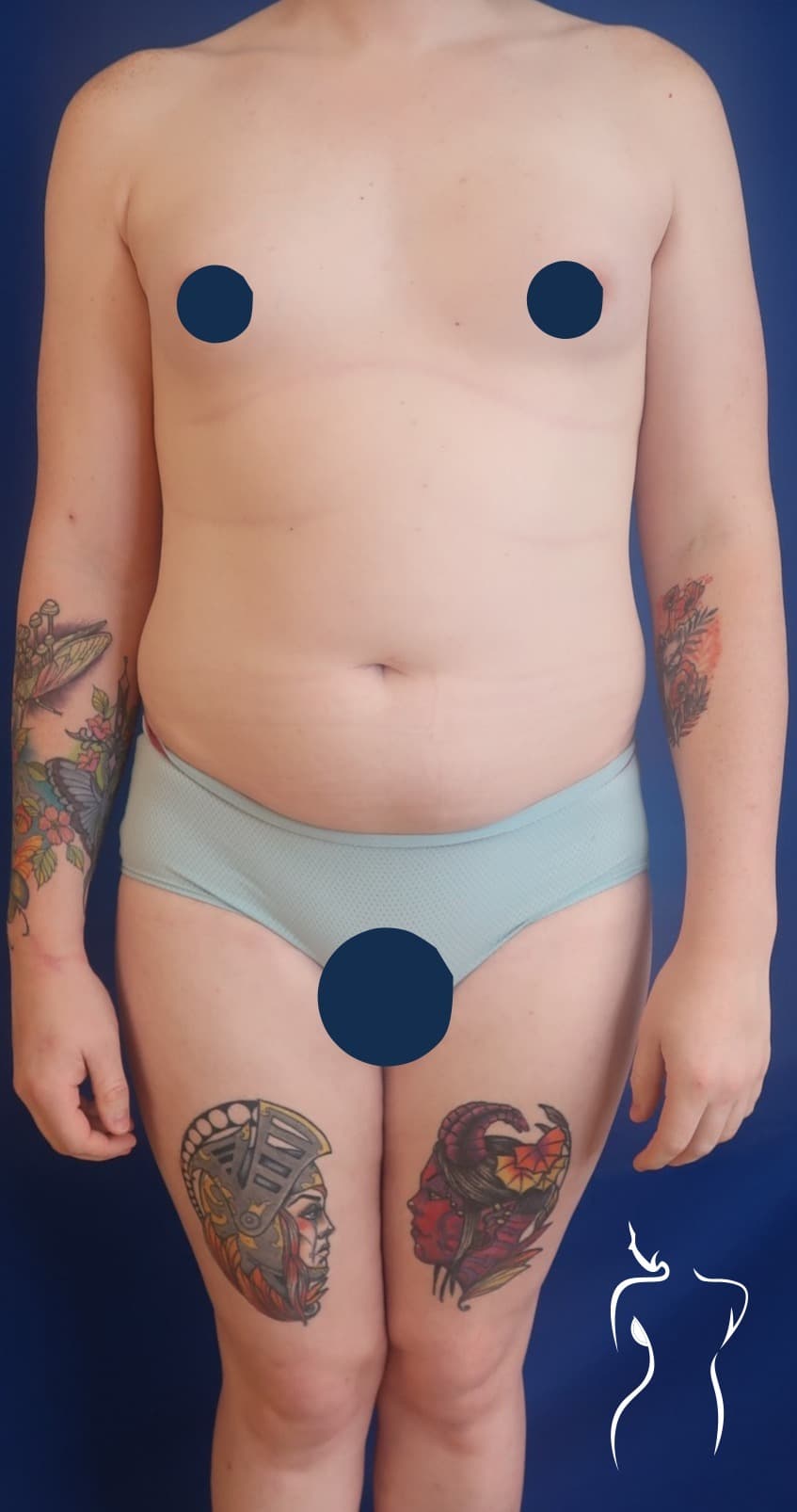 Brazilian Butt Lift, before — actual patient of Dr. Day