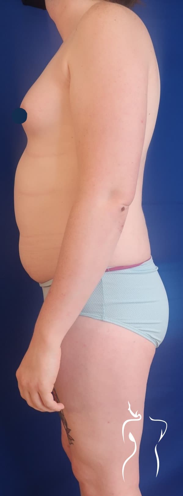 Brazilian Butt Lift (Side Views), before — actual patient of Dr. Day
