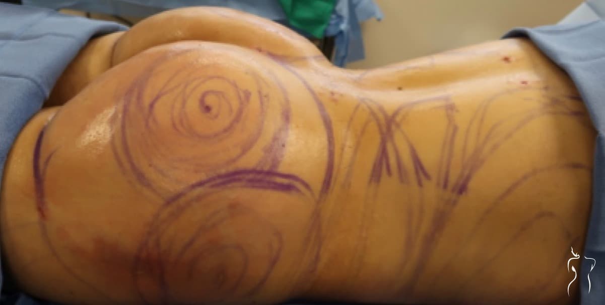 Brazilian Butt Lift, after — actual patient of Dr. Day