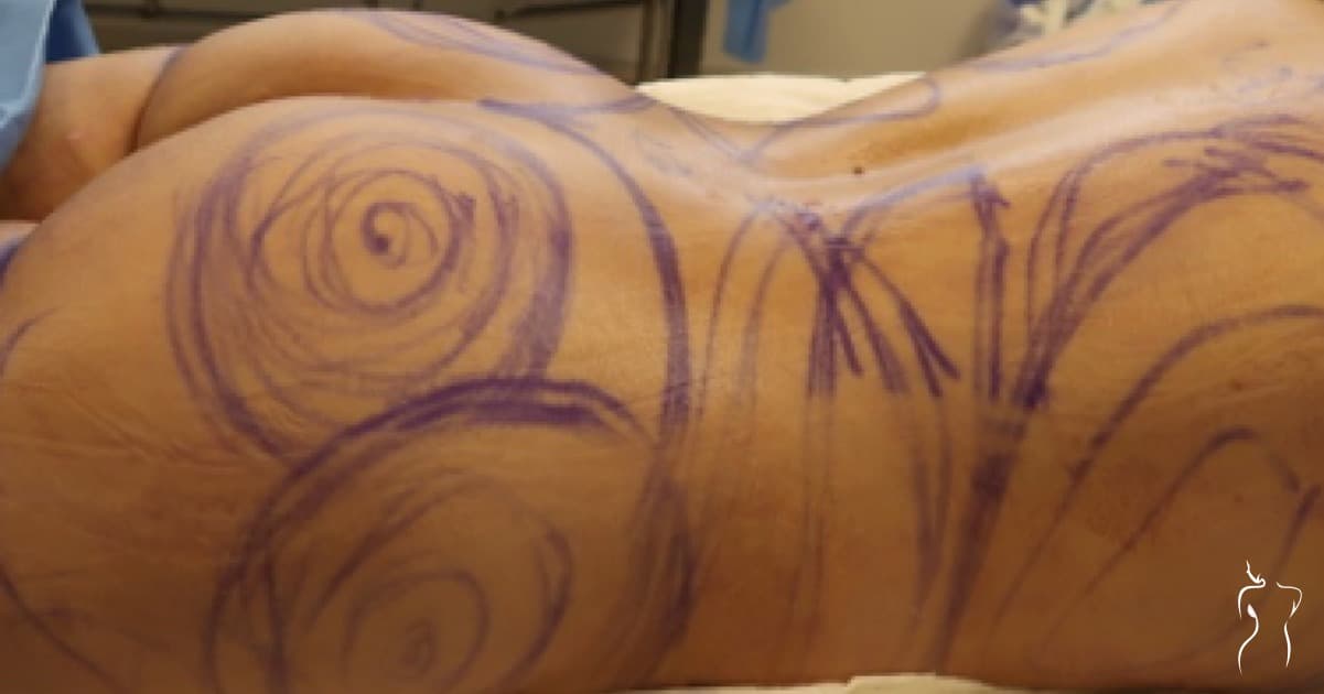 Brazilian Butt Lift, before — actual patient of Dr. Day