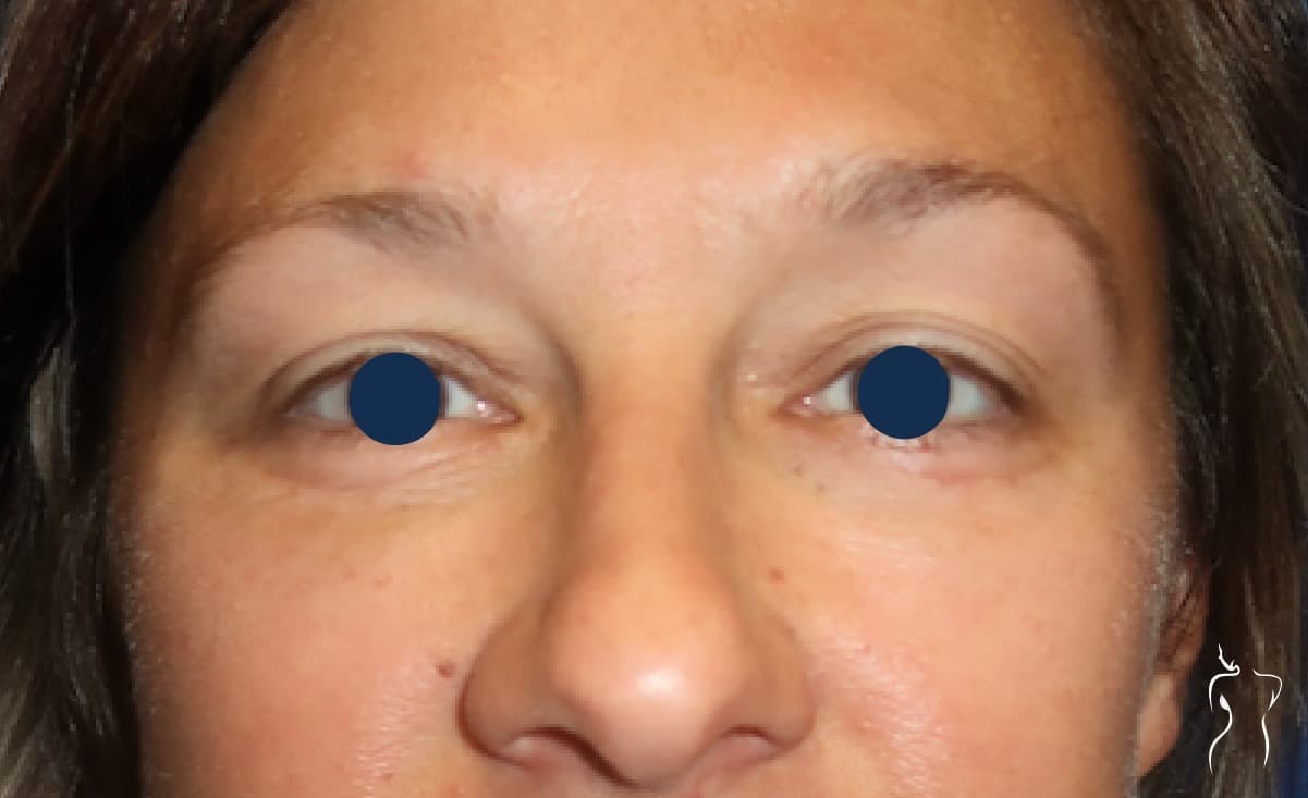 Blepharoplasty, after — actual patient of Dr. Day