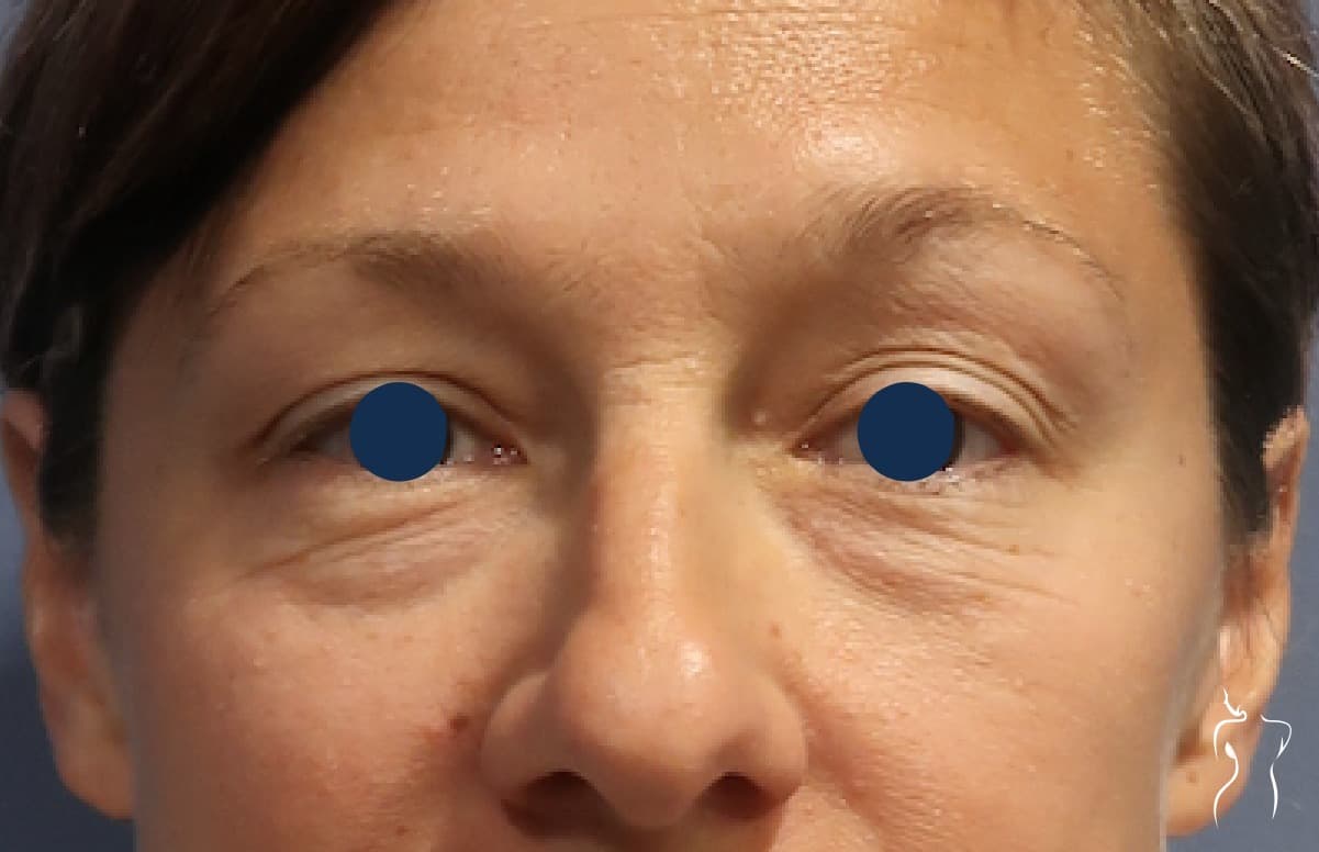 Blepharoplasty, before — actual patient of Dr. Day