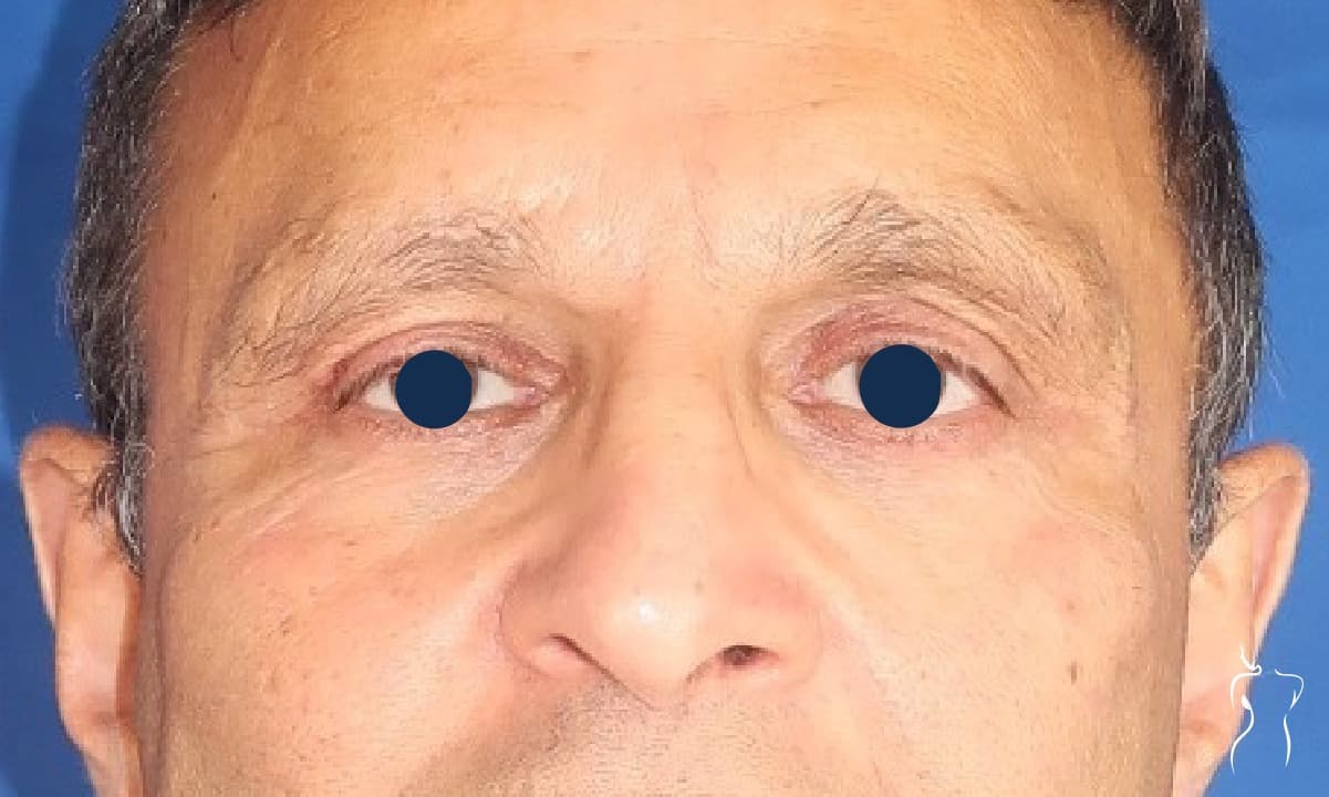 Blepharoplasty, after — actual patient of Dr. Day