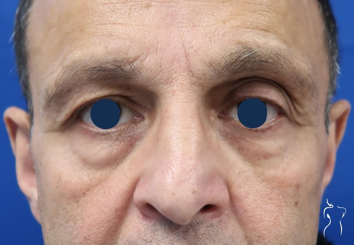 Blepharoplasty, before — actual patient of Dr. Day