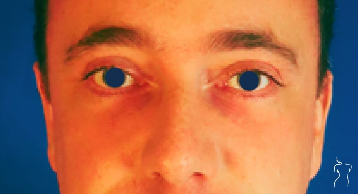 Blepharoplasty, after — actual patient of Dr. Day