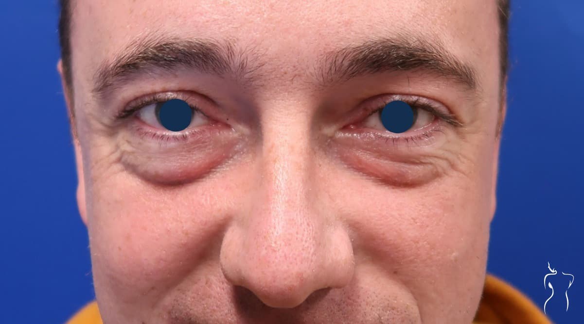 Blepharoplasty, before — actual patient of Dr. Day
