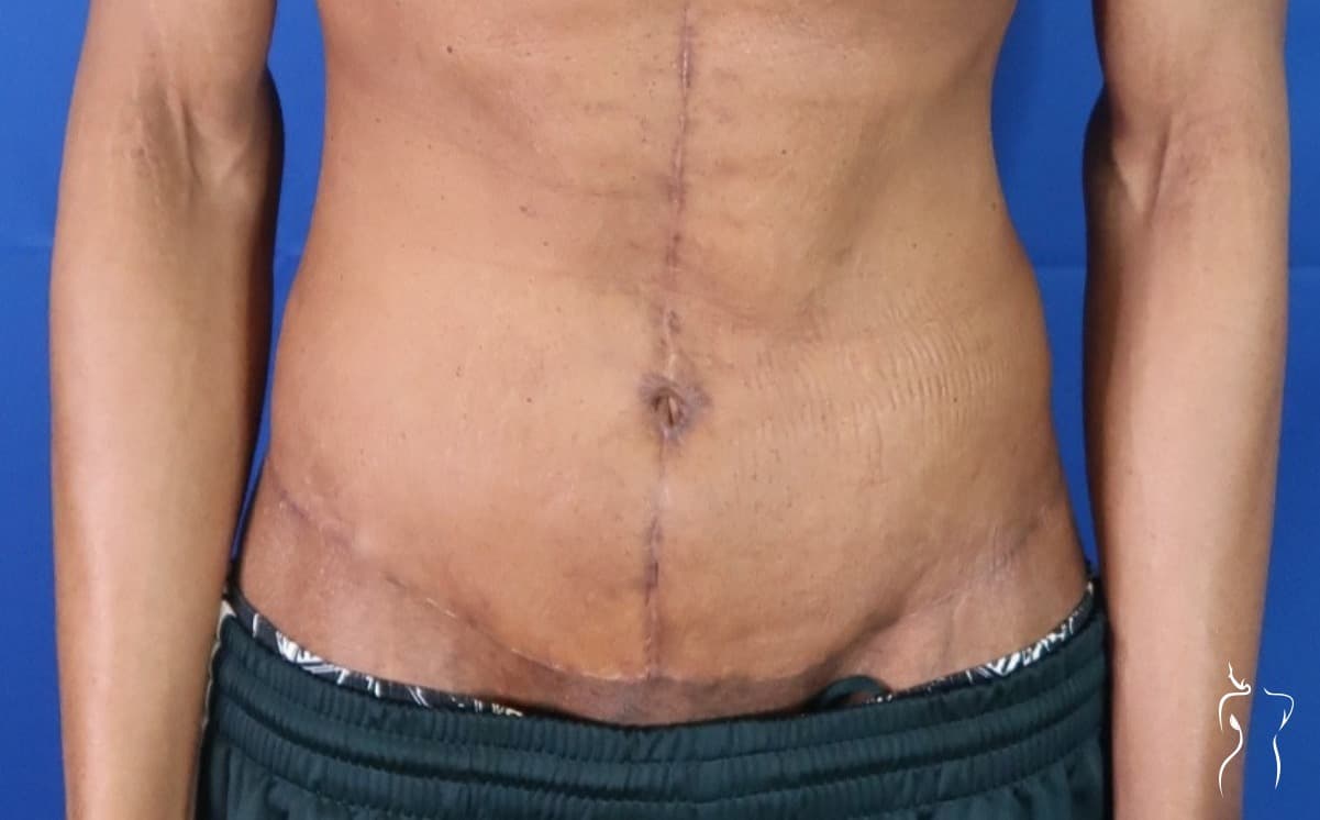 Body Lift, after — actual patient of Dr. Day