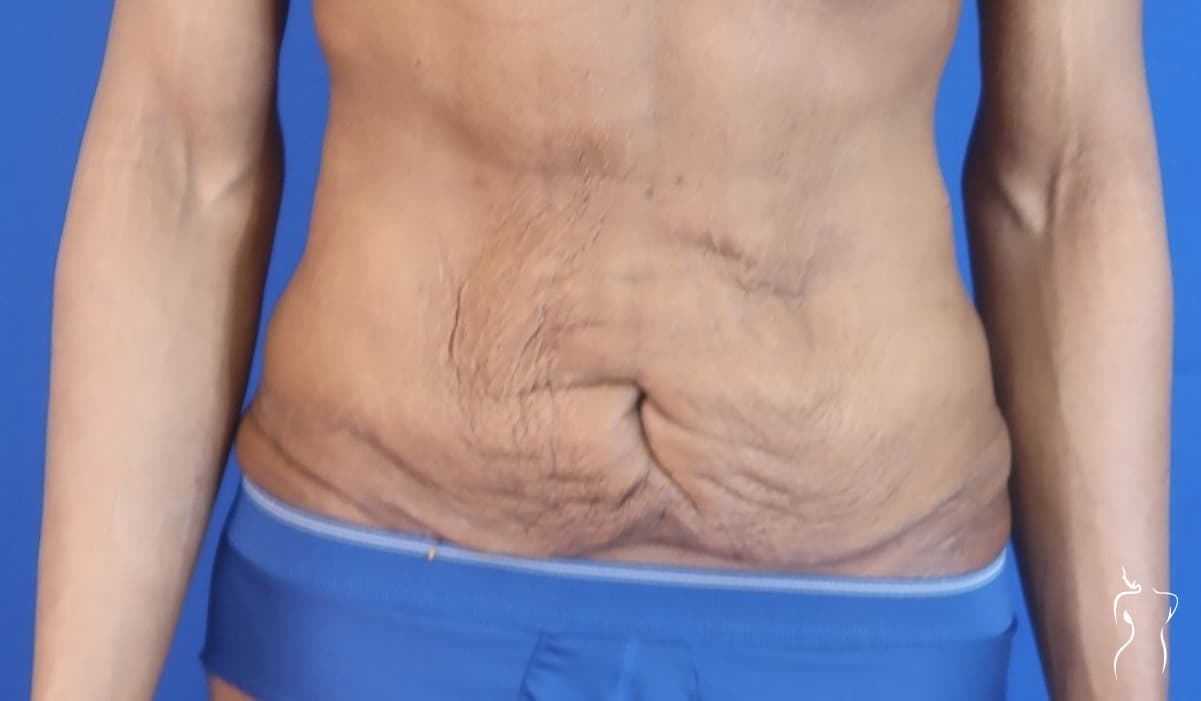 Body Lift, before — actual patient of Dr. Day