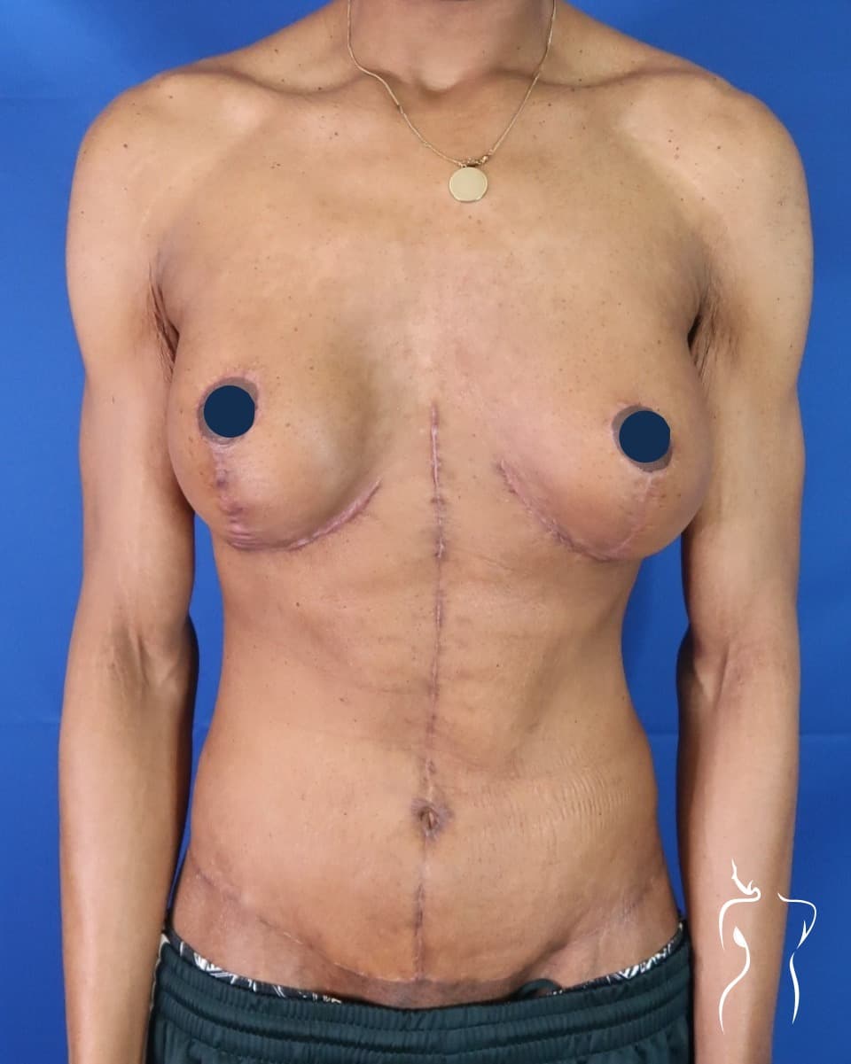 Body Lift, after — actual patient of Dr. Day