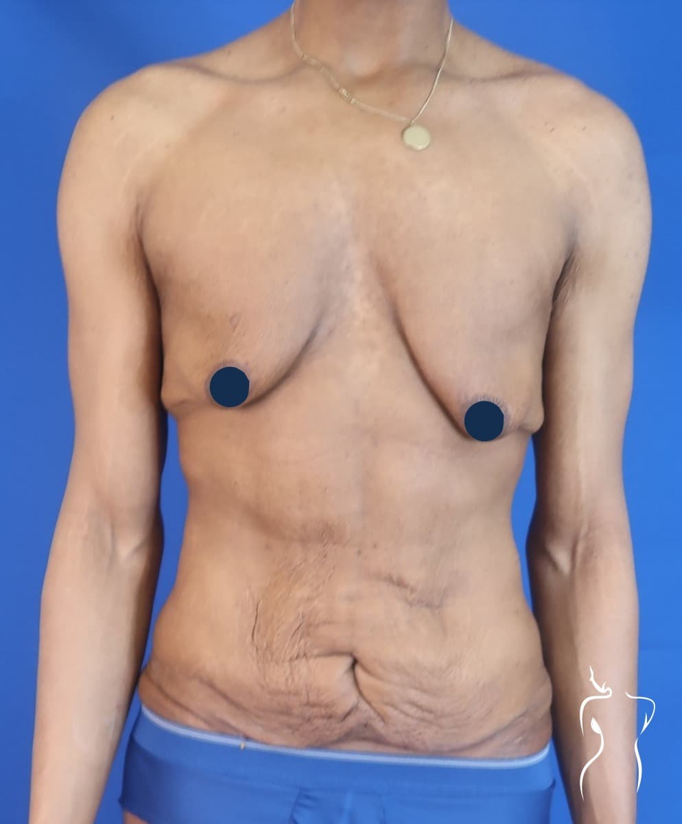 Body Lift, before — actual patient of Dr. Day