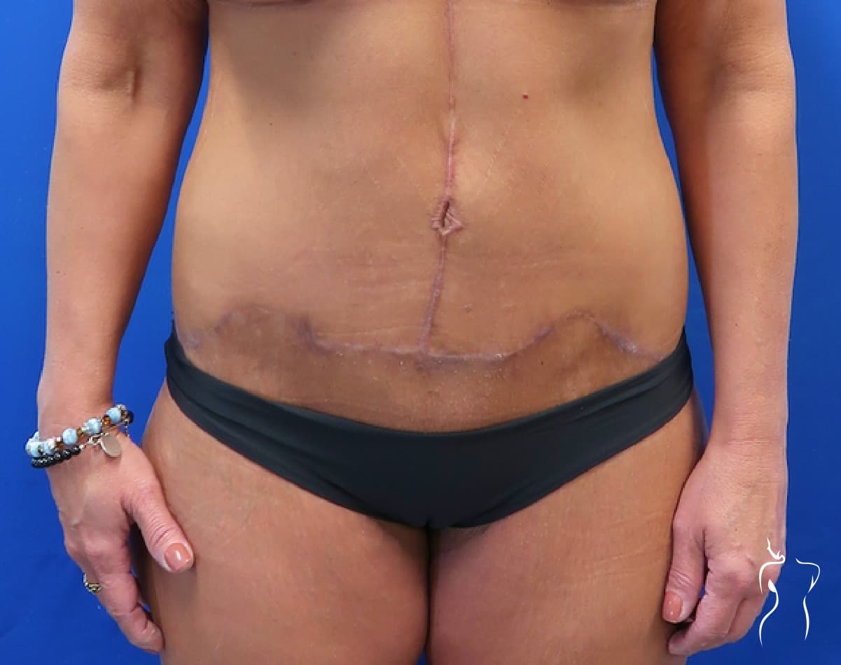 Body Lift, after — actual patient of Dr. Day