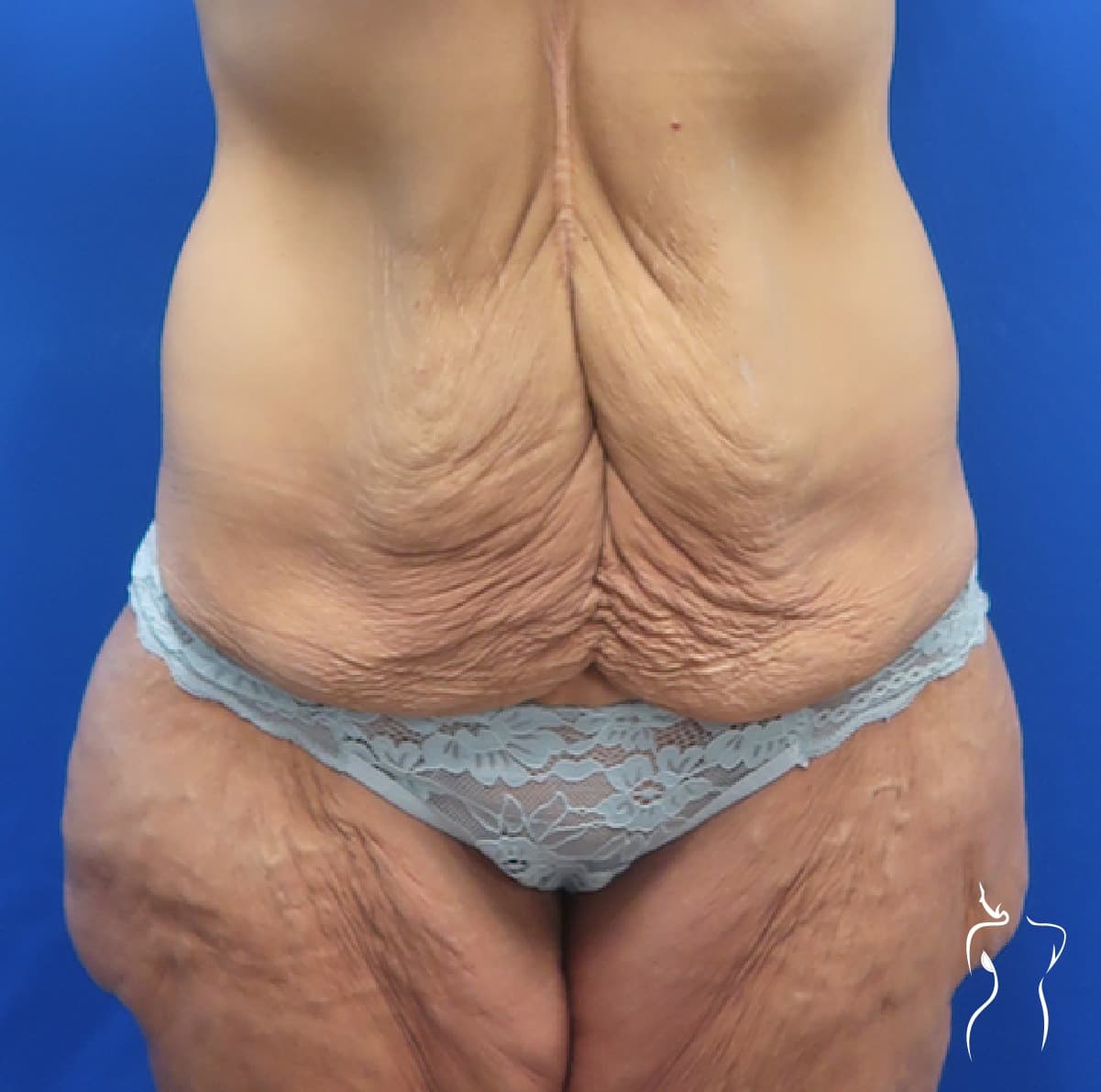 Body Lift, before — actual patient of Dr. Day