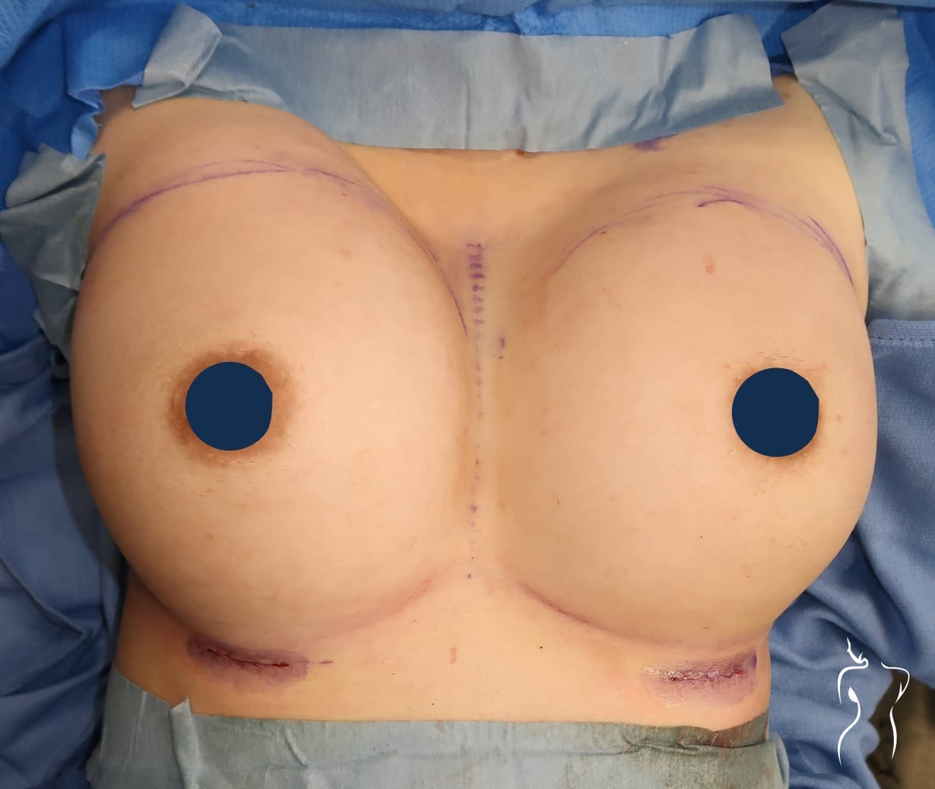 Breast Augmentation, after — actual patient of Dr. Day
