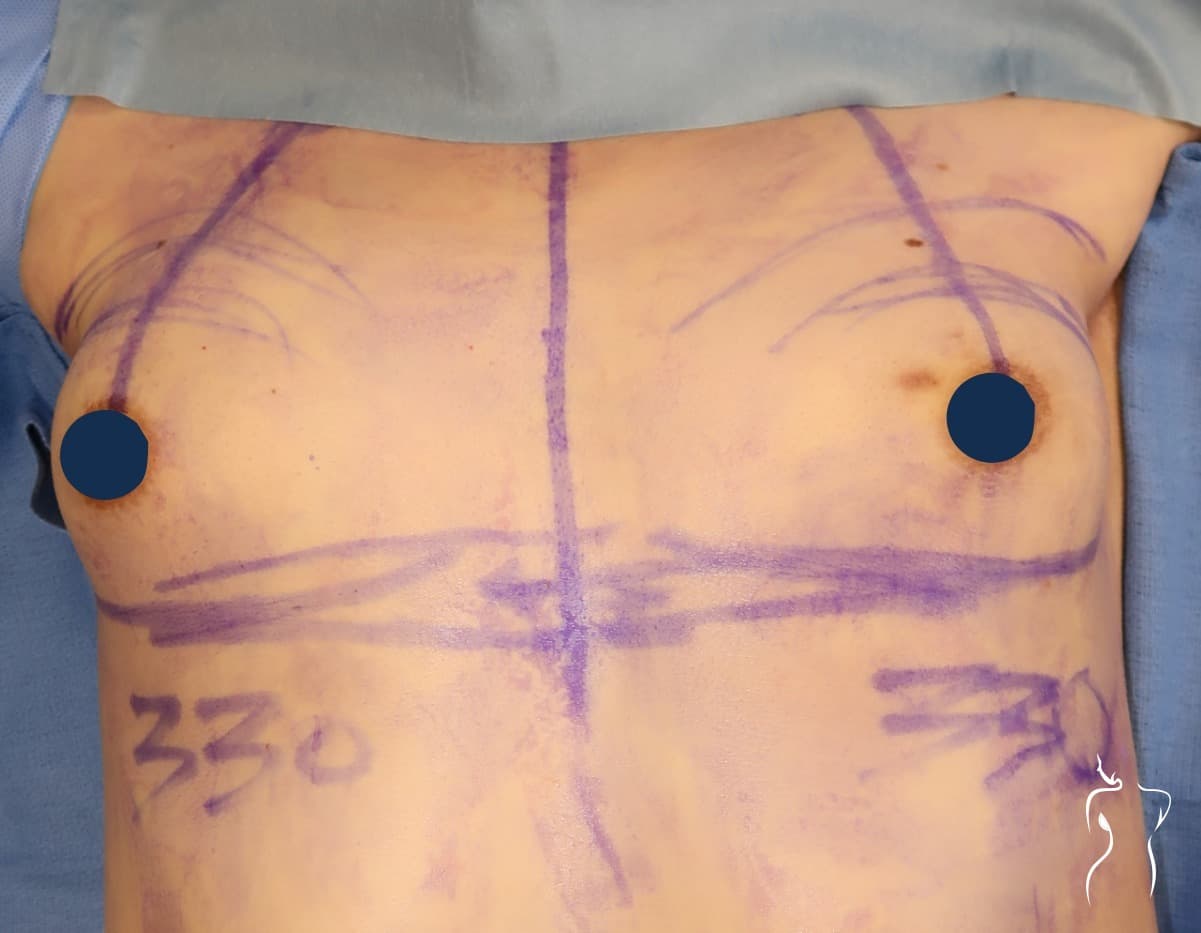 Breast Augmentation, before — actual patient of Dr. Day