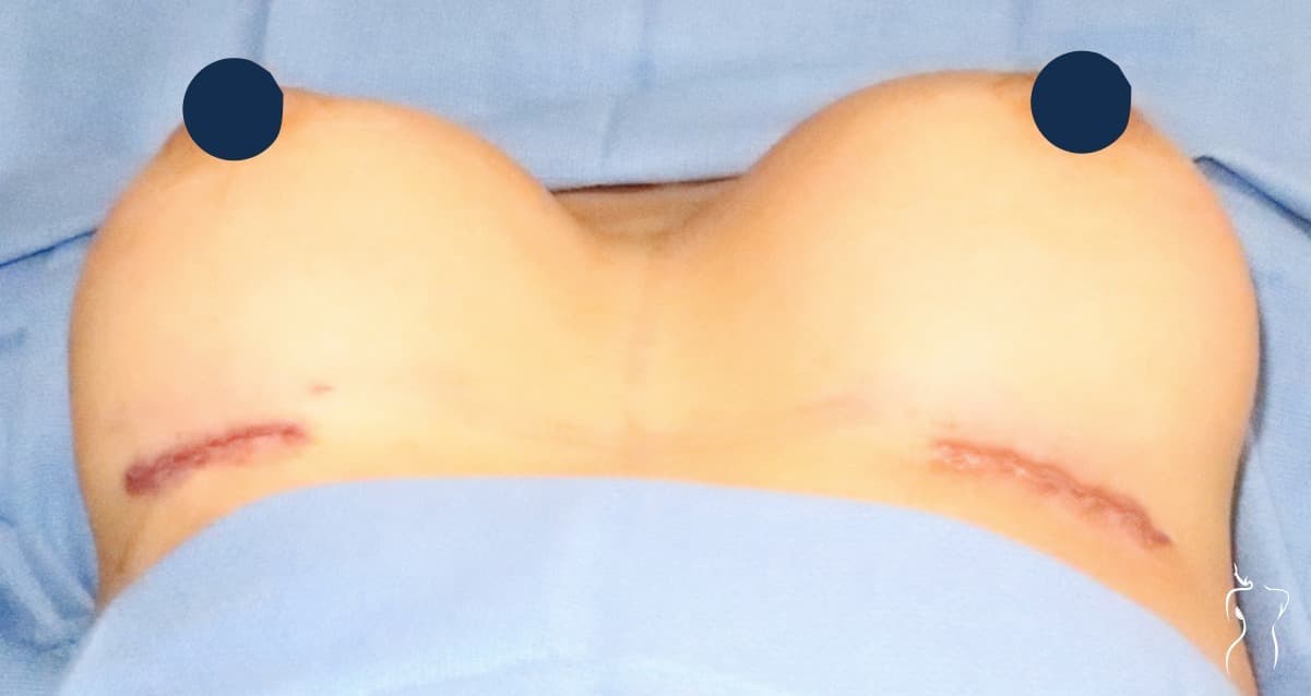 Breast Augmentation, after — actual patient of Dr. Day