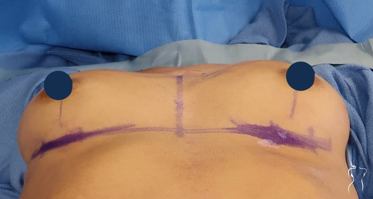 Breast Augmentation, before — actual patient of Dr. Day
