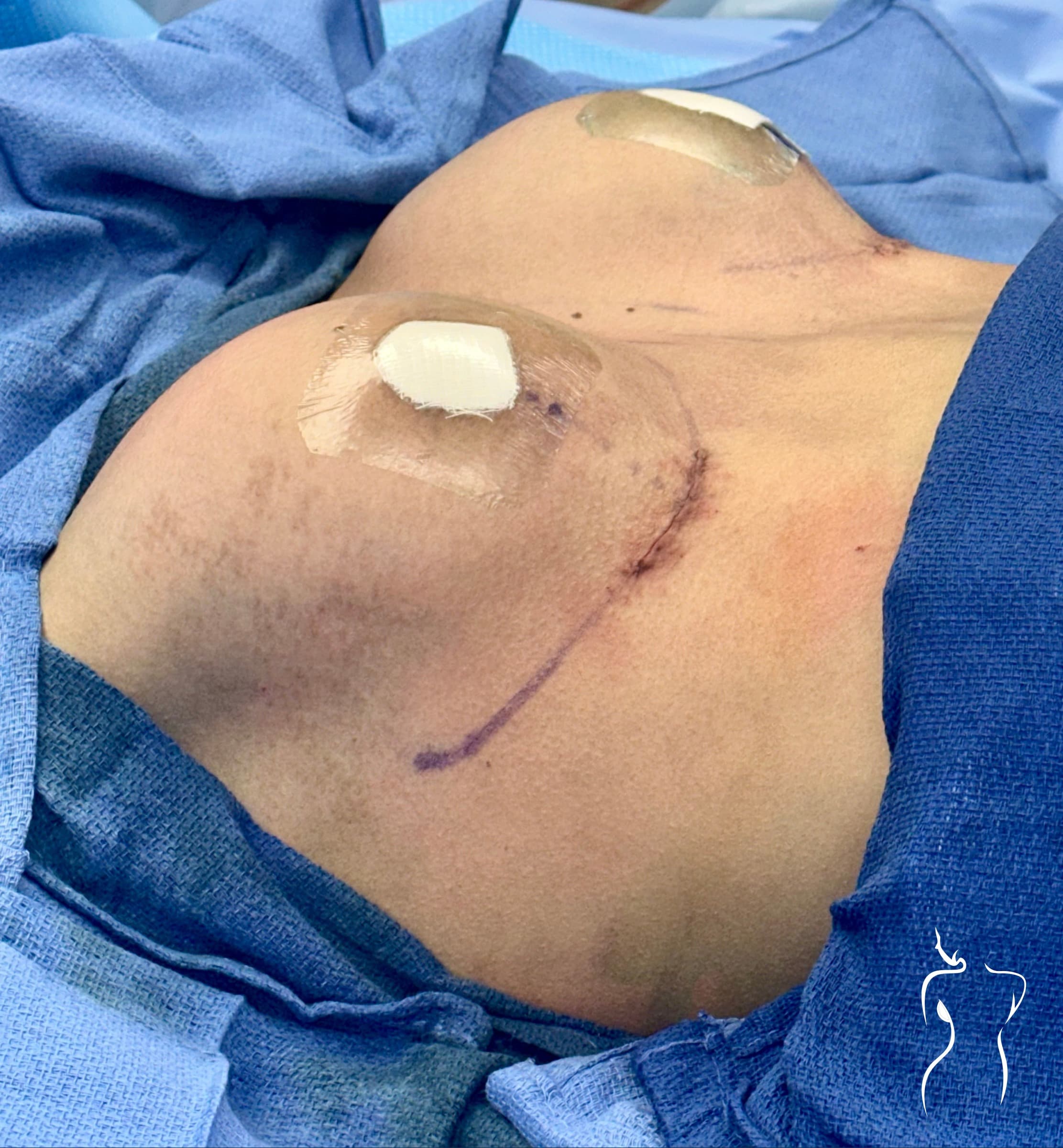 Breast Augmentation, after — actual patient of Dr. Day