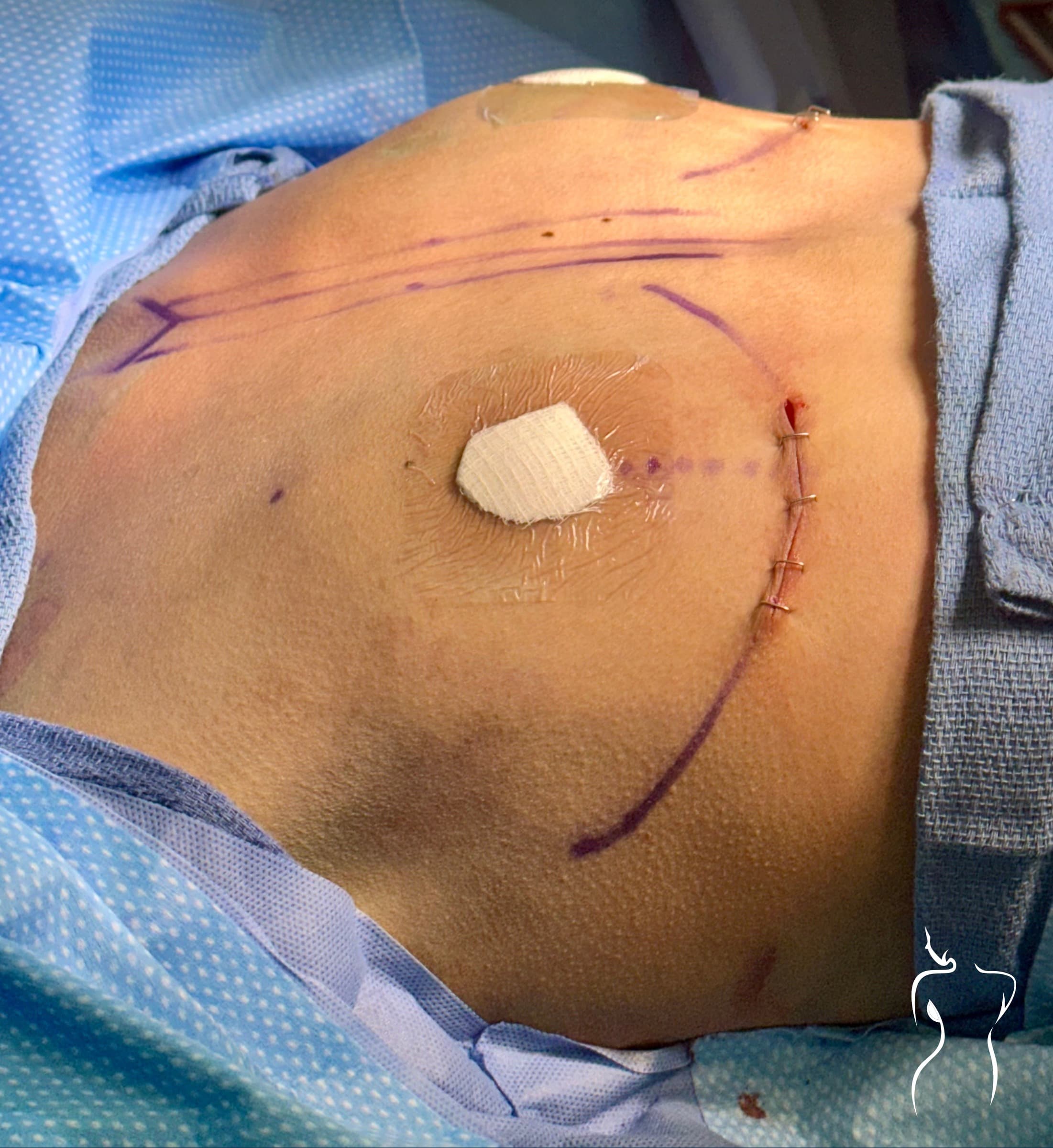 Breast Augmentation, before — actual patient of Dr. Day