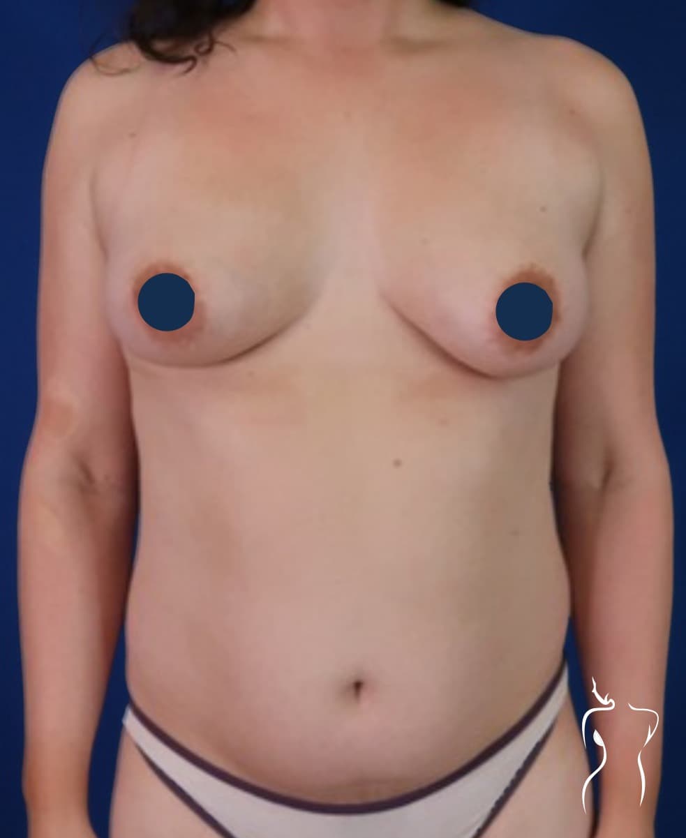Breast Augmentation, before — actual patient of Dr. Day