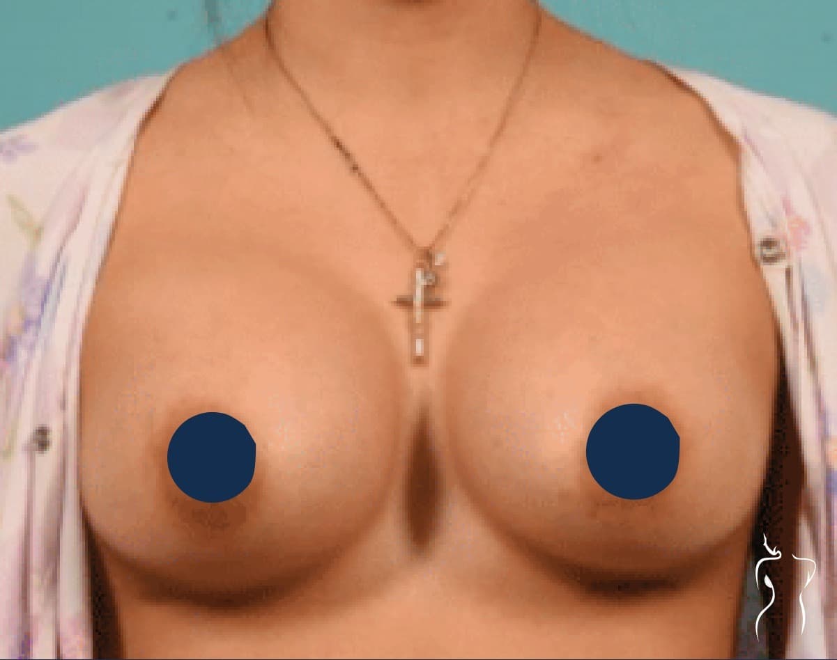 Breast Augmentation, after — actual patient of Dr. Day