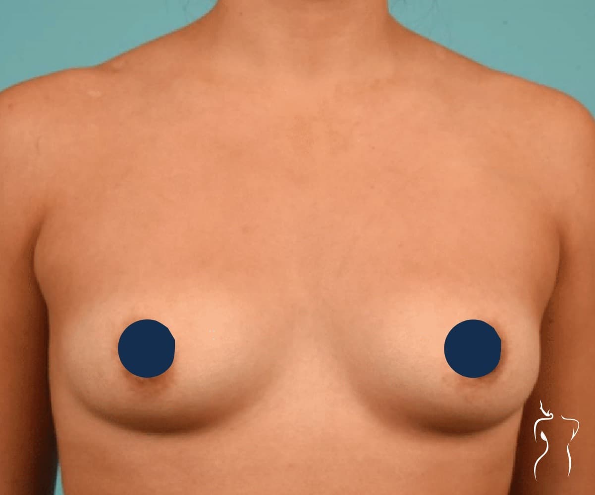 Breast Augmentation, before — actual patient of Dr. Day