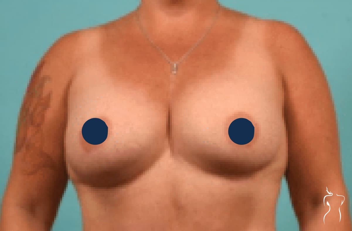 Breast Augmentation, after — actual patient of Dr. Day