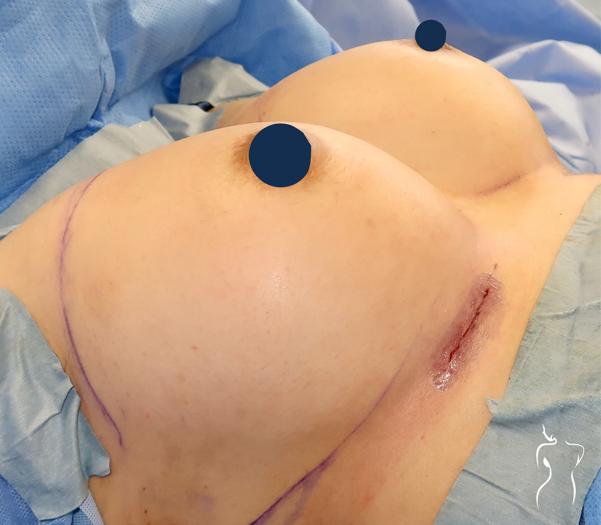 Breast Augmentation, after — actual patient of Dr. Day