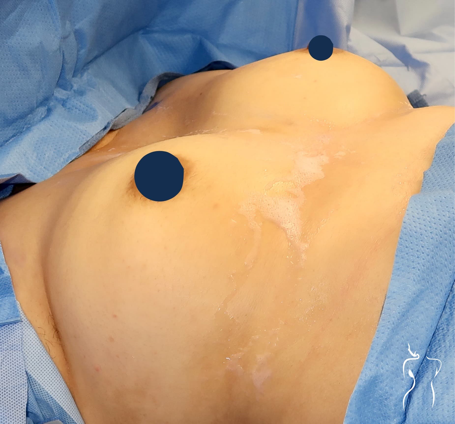 Breast Augmentation, before — actual patient of Dr. Day