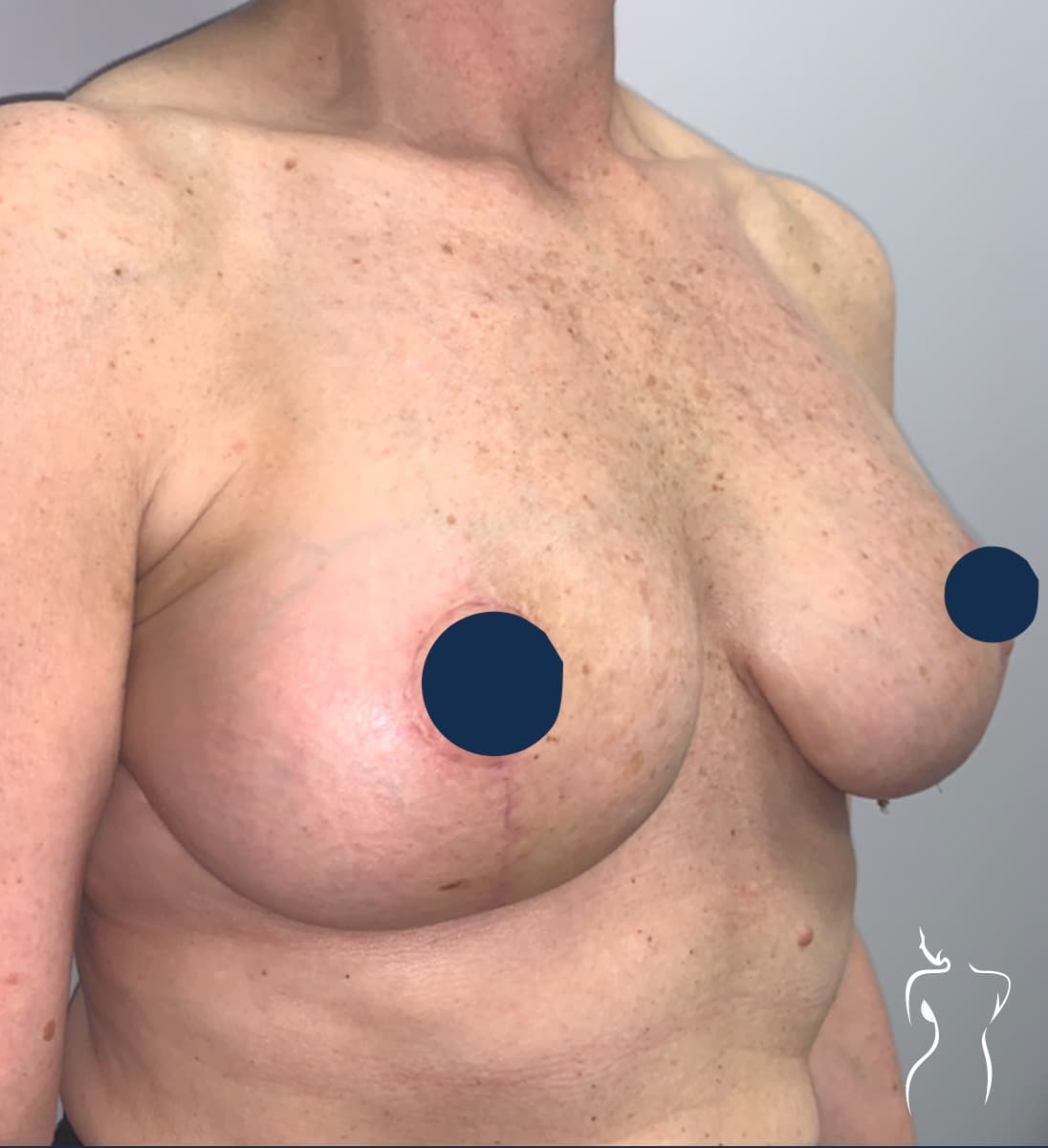 Breast Lift, after — actual patient of Dr. Day