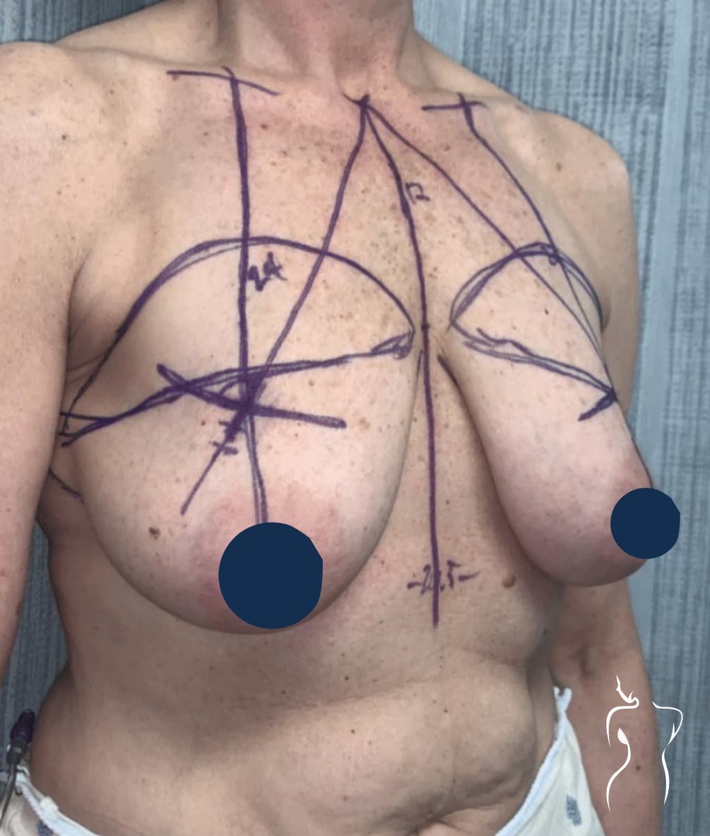 Breast Lift, before — actual patient of Dr. Day