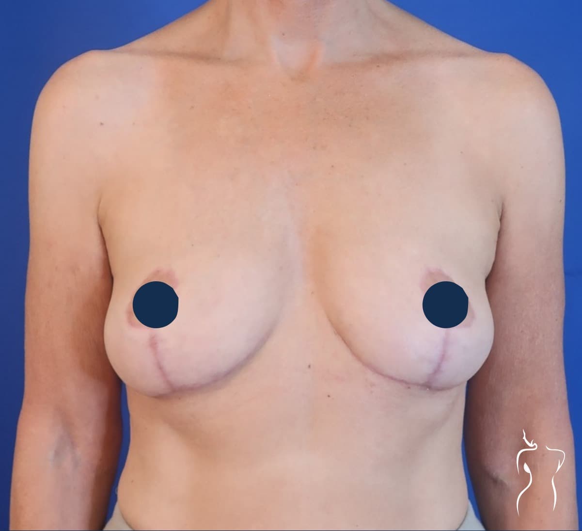 Breast Lift, after — actual patient of Dr. Day