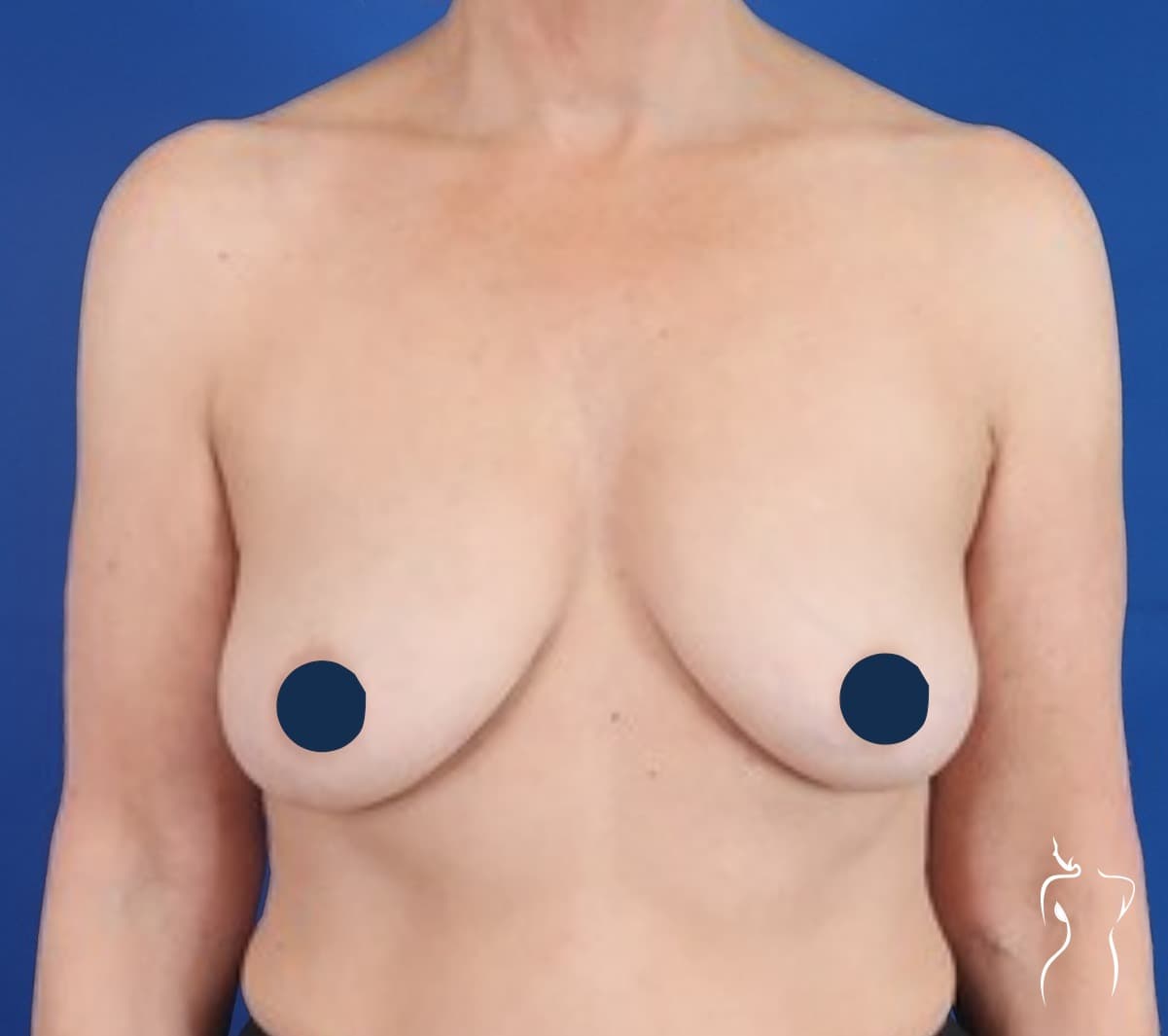 Breast Lift, before — actual patient of Dr. Day
