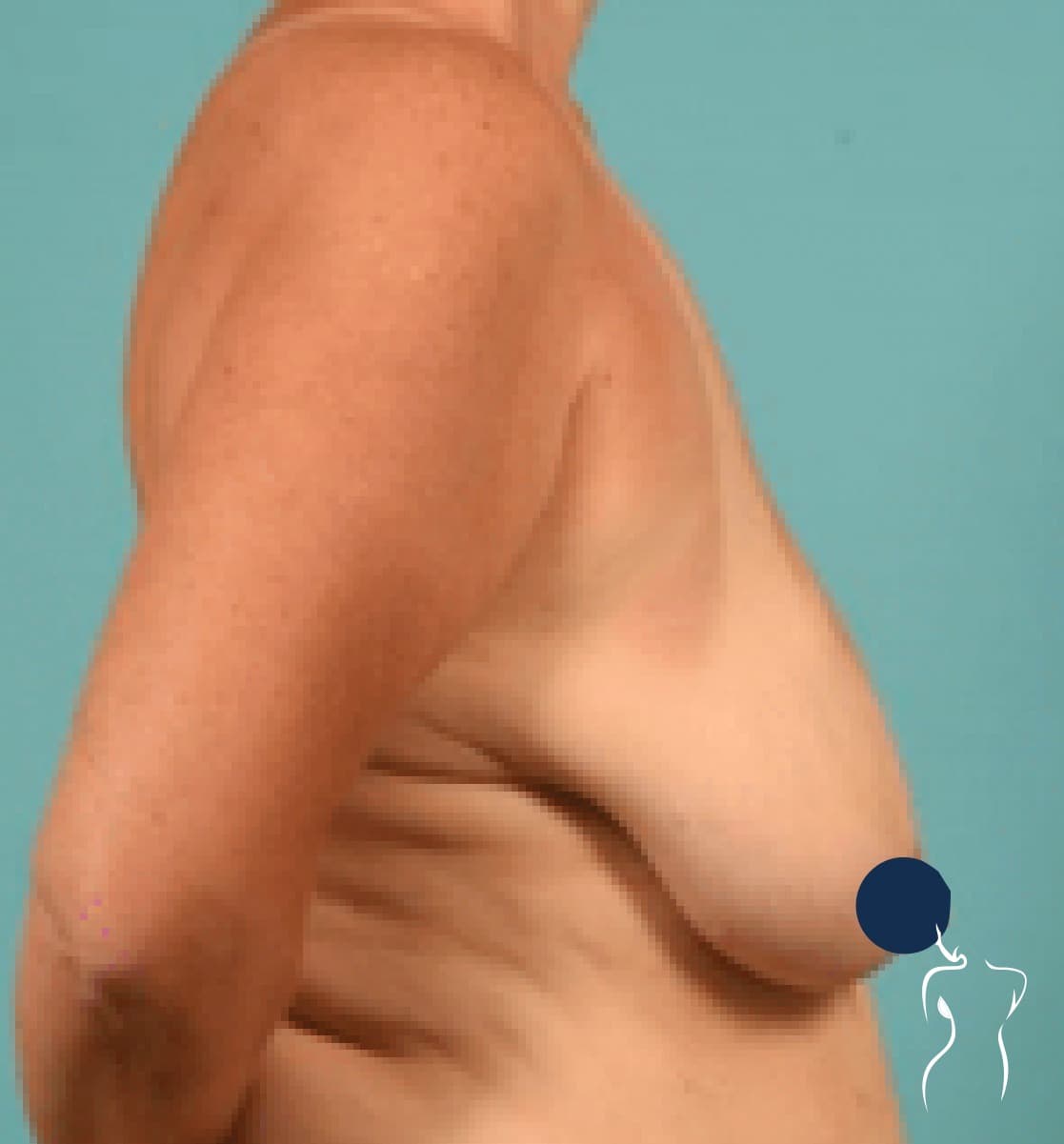Breast Lift, before — actual patient of Dr. Day