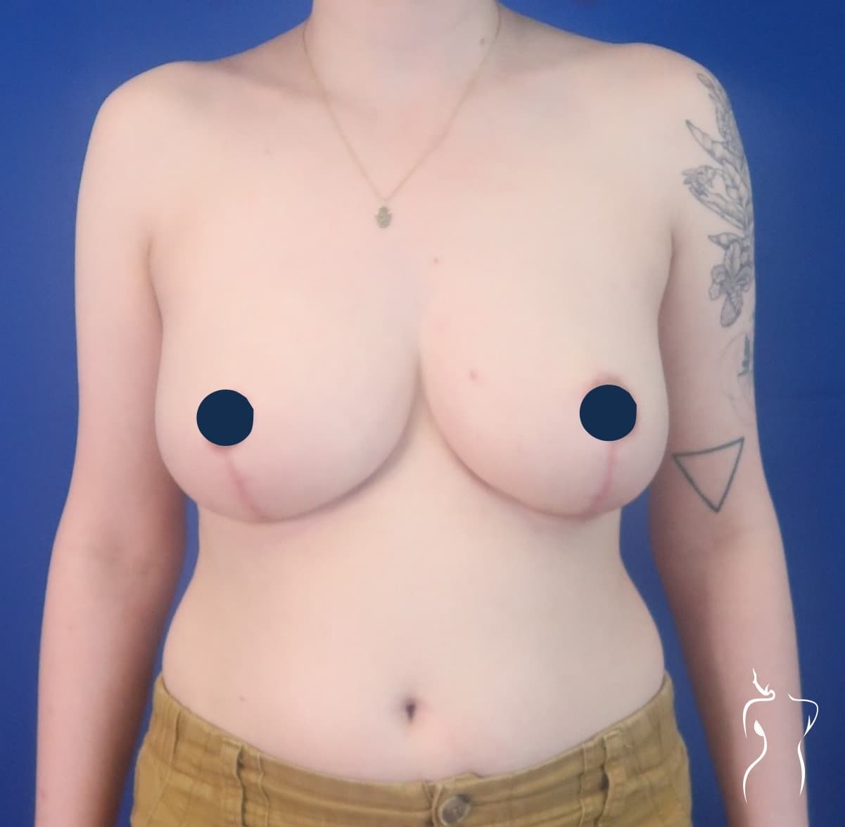 Breast Reduction, after — actual patient of Dr. Day