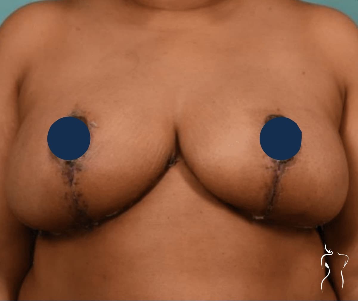 Breast Reduction, after — actual patient of Dr. Day
