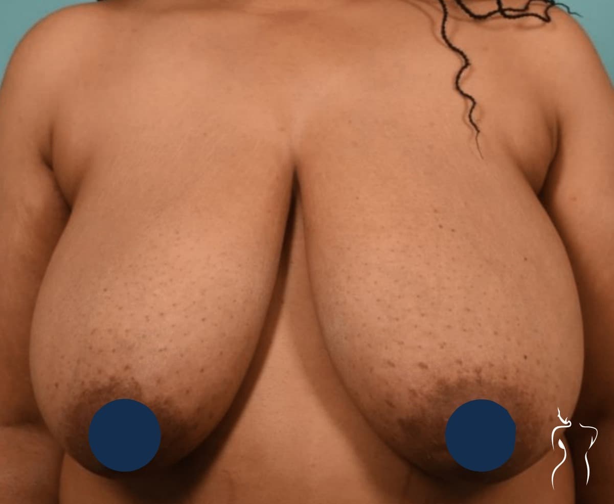 Breast Reduction, before — actual patient of Dr. Day