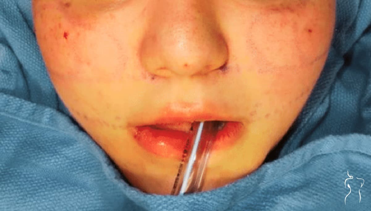 Buccal Fat Excision, after — actual patient of Dr. Day