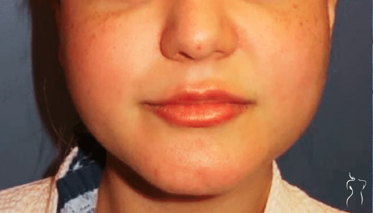 Buccal Fat Excision, before — actual patient of Dr. Day